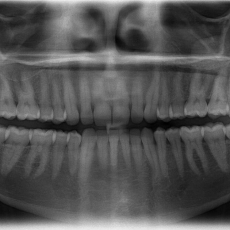X-Ray of All 32 Human Teeth